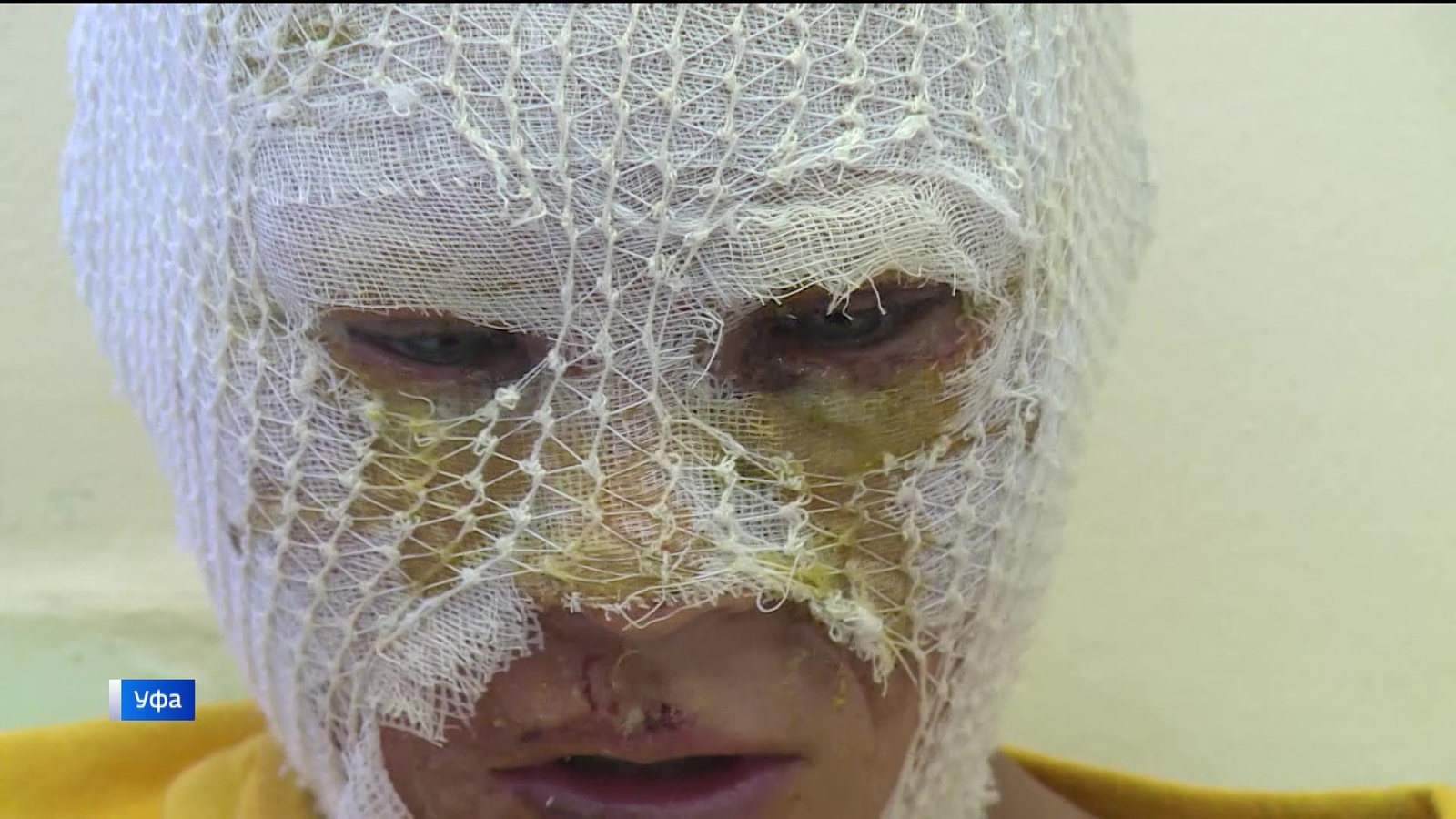 В Башкирии дети обожгли лица порохом